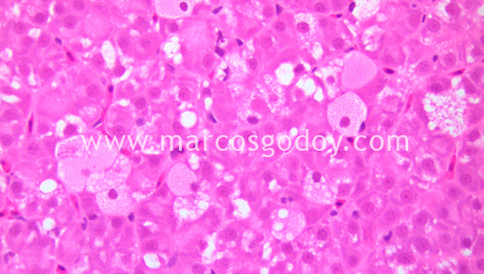 ground-glass-hepatocyte-iii