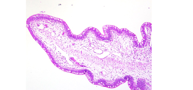 Gut edema histopathology V