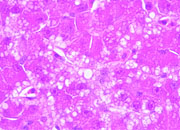 Microvesicular steatosis small